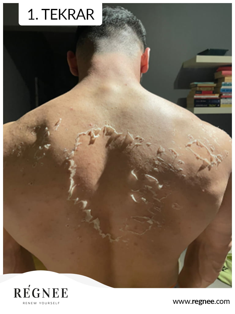 Yosun Peeling Soyulma Ne Zaman Gerçekleşir? Cilt Soyulması ve Yenilenme Süreci 1