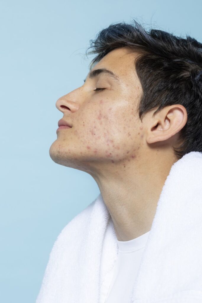 6. Régnee Anti Blemish Yosun Peeling Protokolü ile Akne Tedavisi