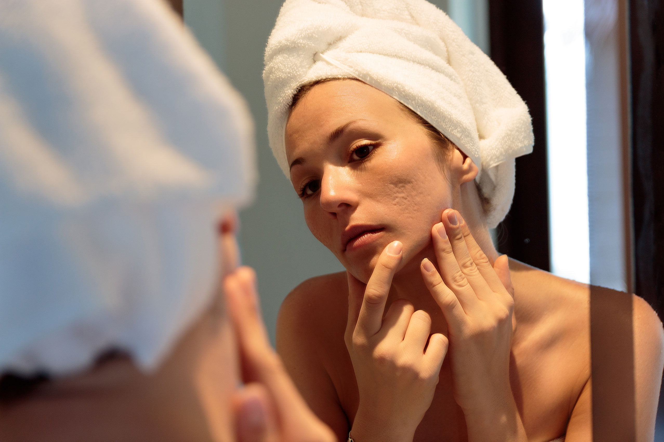 yosun peeling ile doku kaybı tedavisi