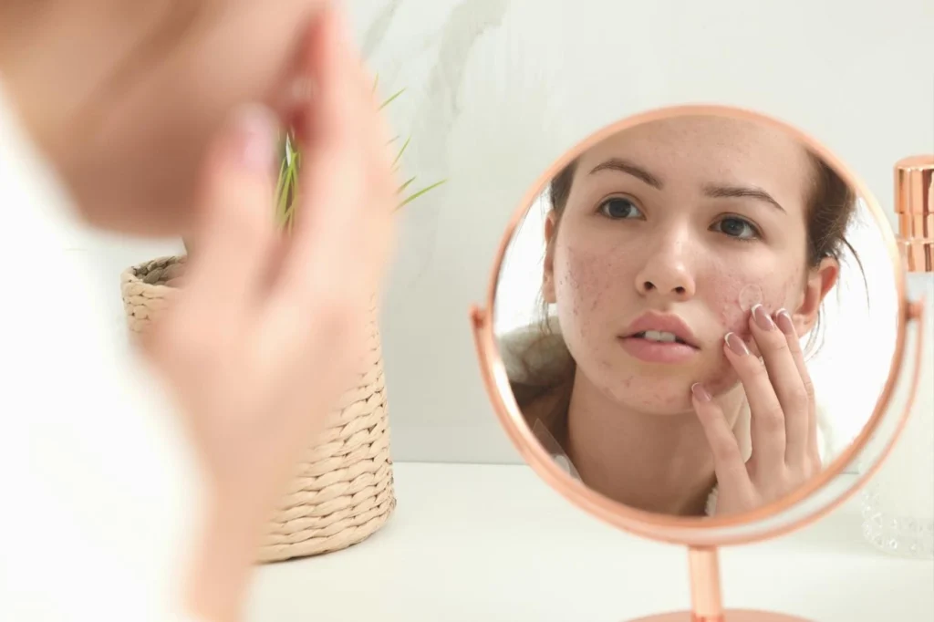 yosun peeling ile doku kaybı tedavisi