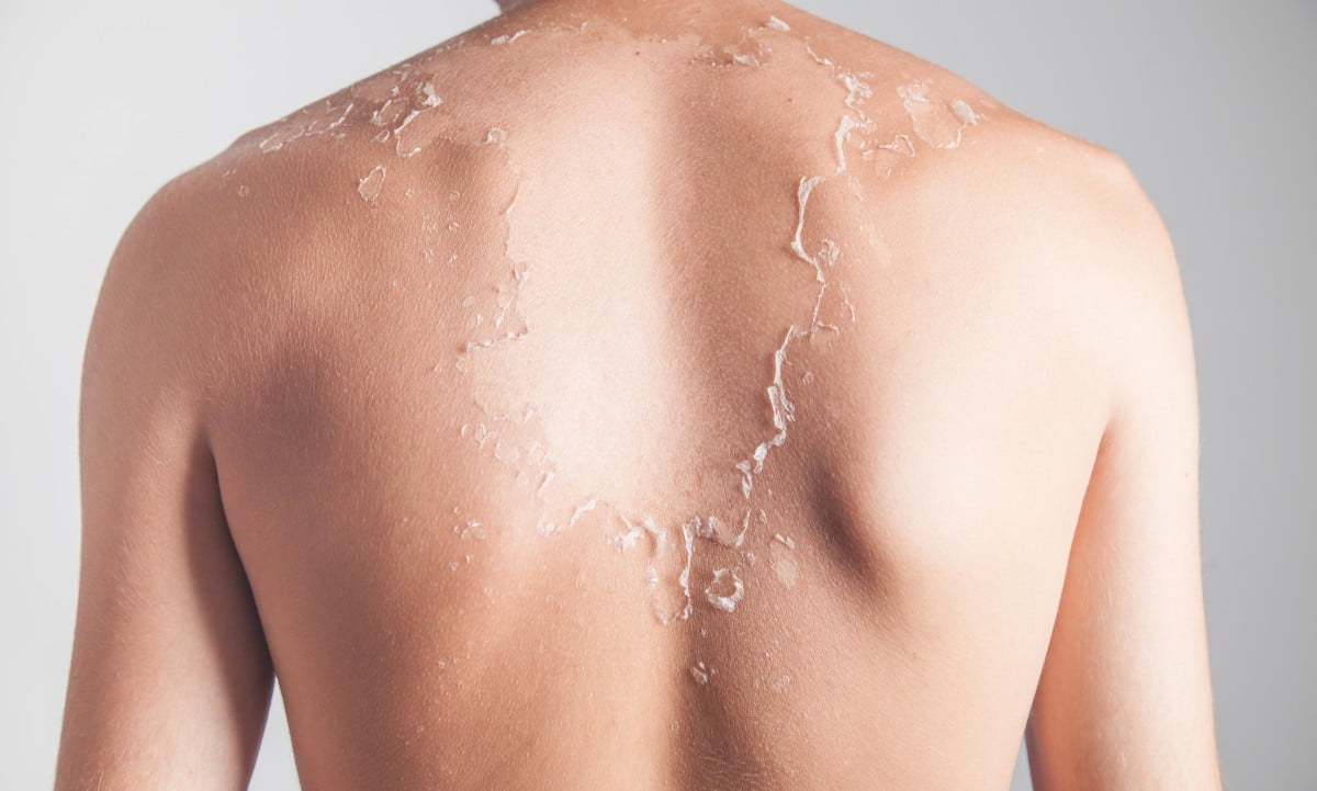 Yosun peeling kaç gün arayla yapılır. yosun peeling soyulma ne zaman gerçekleşir?