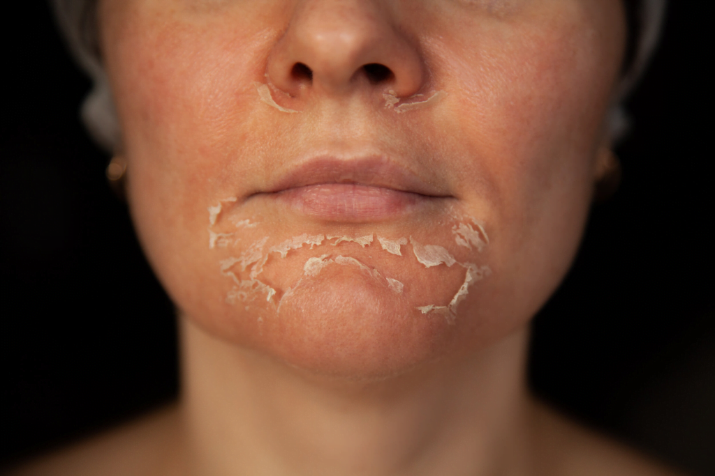 Yosun peeling kaç gün arayla yapılır?