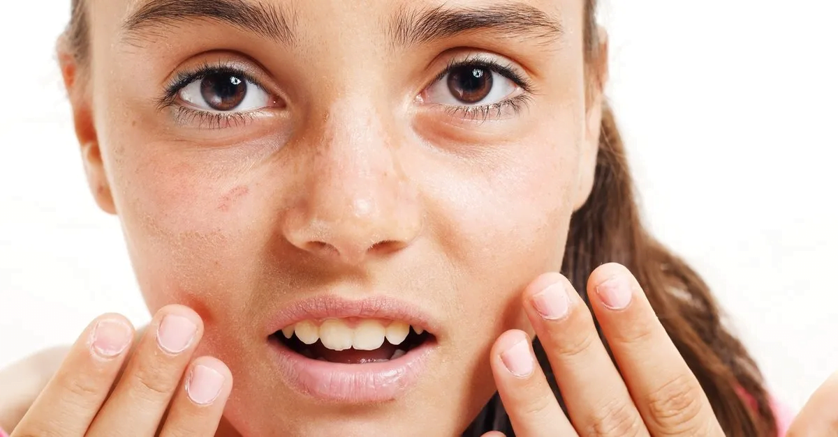 Lekesiz Bir Yüz İçin Ne Yapmalı? Yosun Peeling Cilt Lekelerini Gidermede Ne Kadar Etkili?