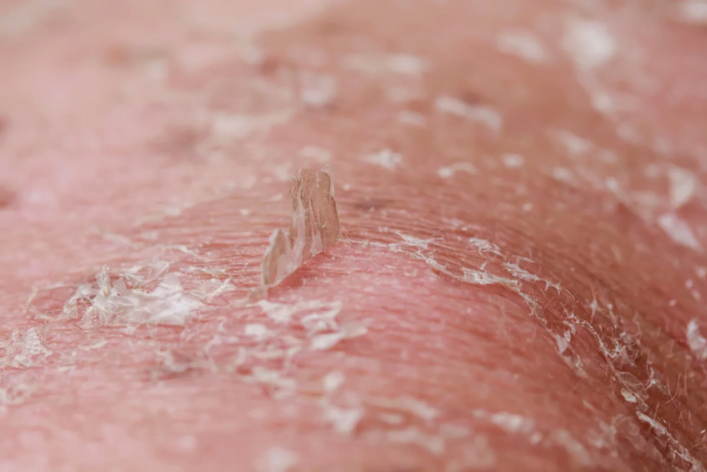 Yosun Peeling Neden Elle Soyulmaz? 1