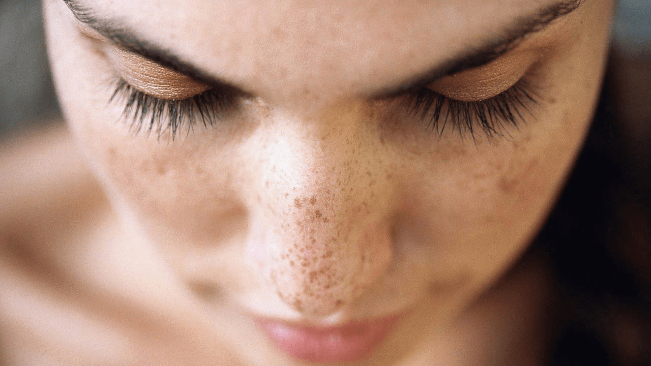 Lekesiz Bir Yüz İçin Ne Yapmalı? Yosun Peeling Cilt Lekelerini Gidermede Ne Kadar Etkili?