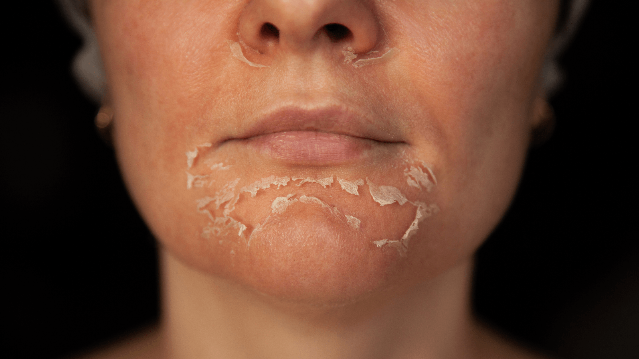 yosun peeling soyulma