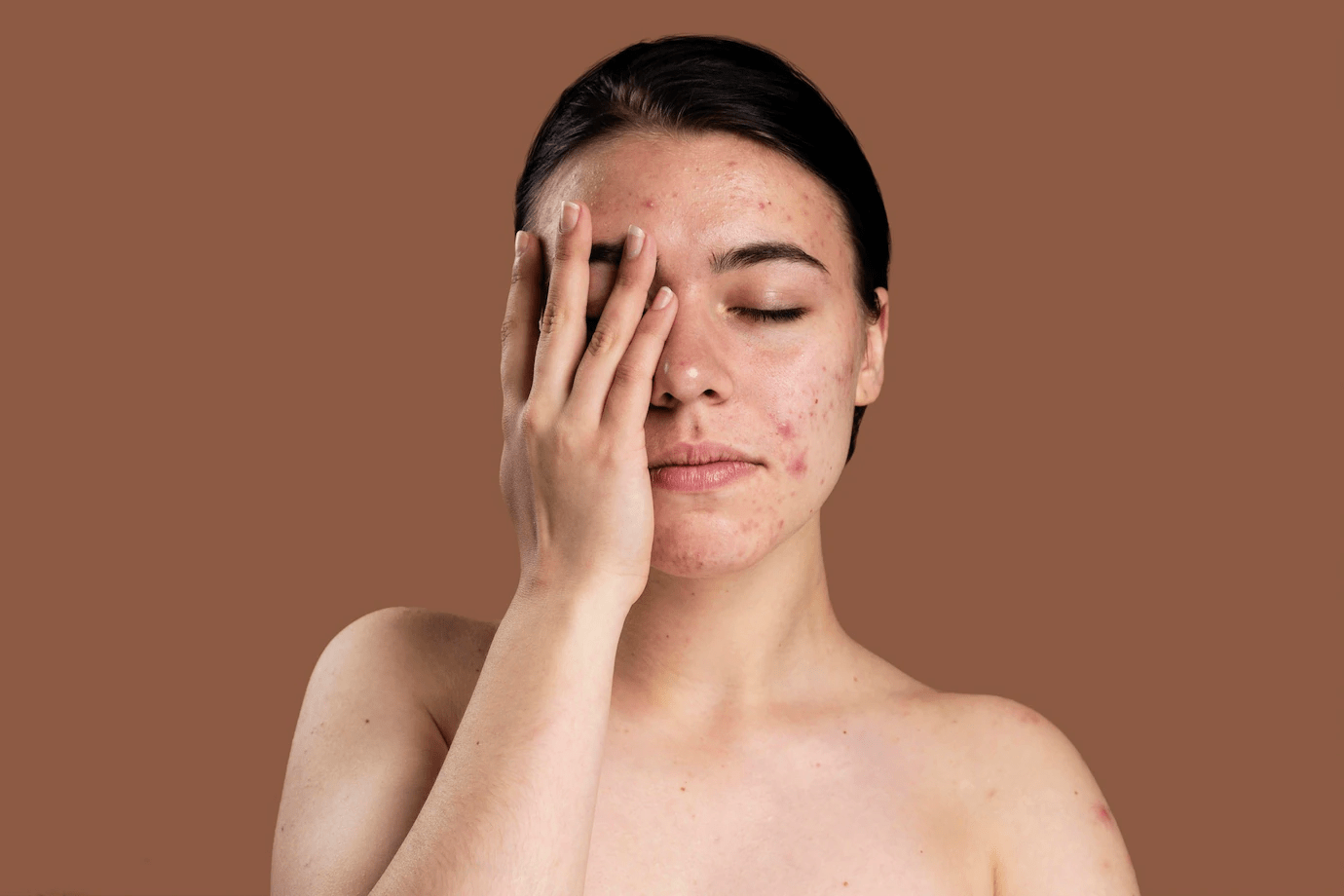 Sivilceli Yüze Yosun Peeling Yapılır mı? Cilt Bakımında Doğal Bir Çözüm mü? 1