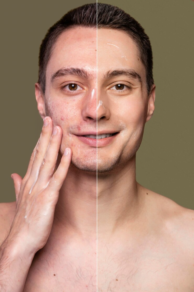 Sivilceli Yüze Yosun Peeling Yapılır mı? Cilt Bakımında Doğal Bir Çözüm mü? 3