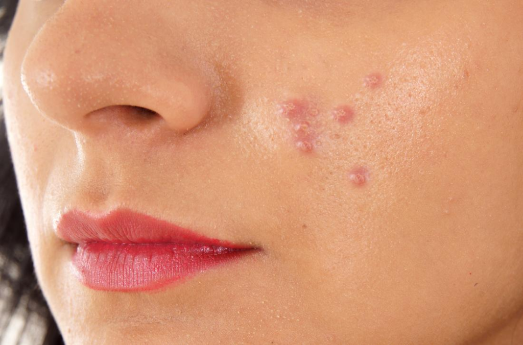 Sivilce Tedavisi Yosun Peeling ile Mümkün mü? 2