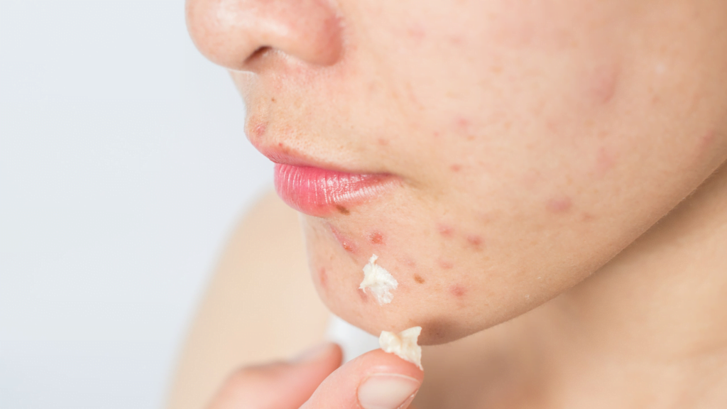 Sivilce Tedavisi Yosun Peeling ile Mümkün mü?