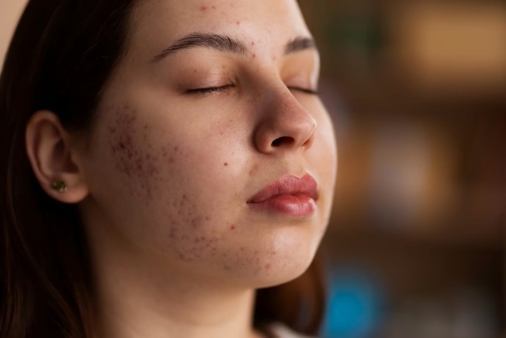 Sivilceli Yüze Yosun Peeling Yapılır mı? Cilt Bakımında Doğal Bir Çözüm mü? 2