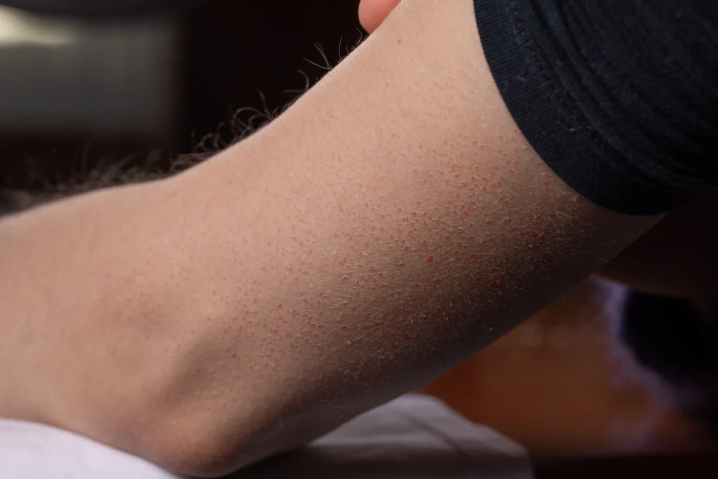 Kollarda Çilek Görünümü: Dermatolojik Bir Sorunun Arkasındaki Gerçekler 3