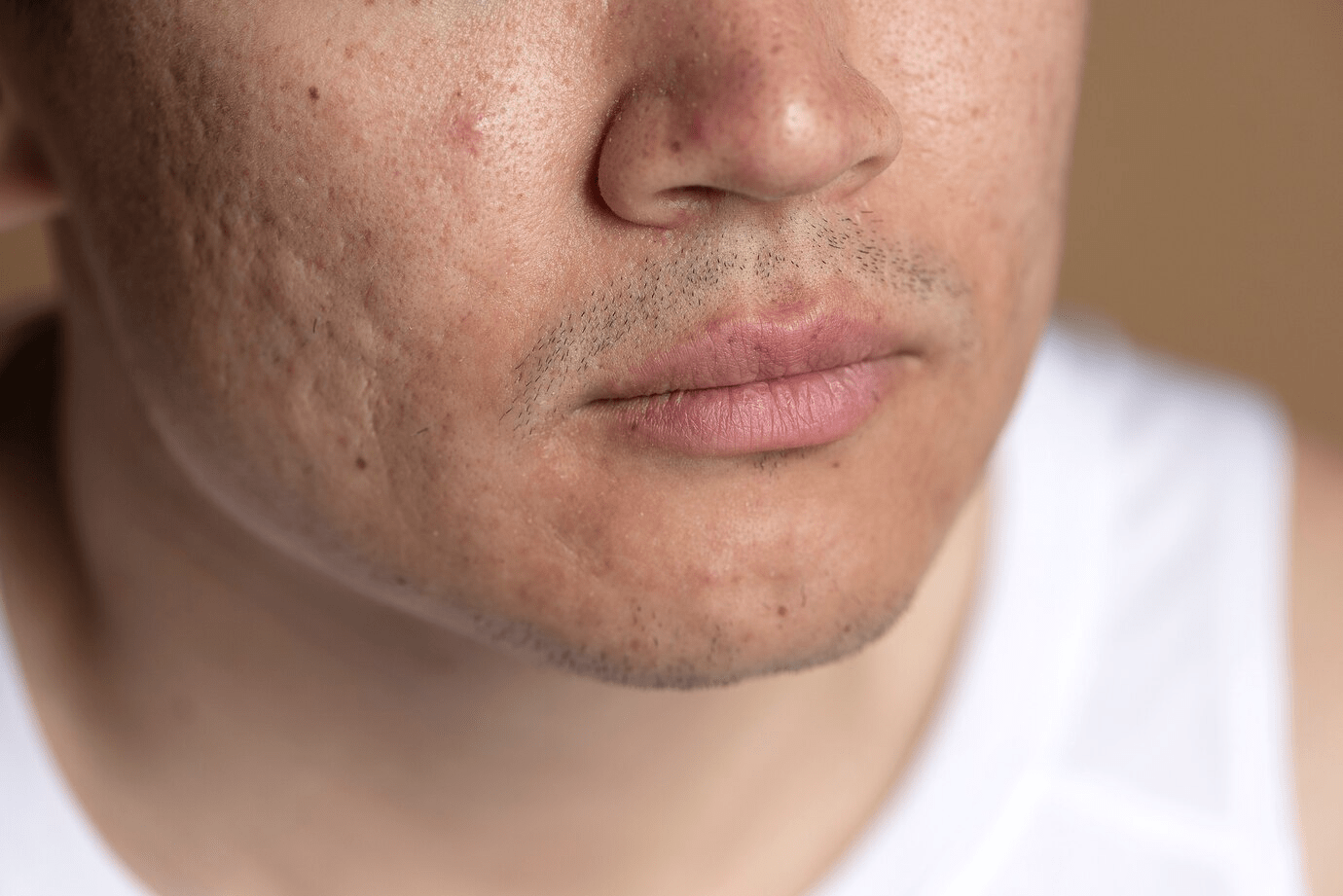 Cilt Çukurlarına Veda: Yosun Peeling Mucizesisini Keşfedin