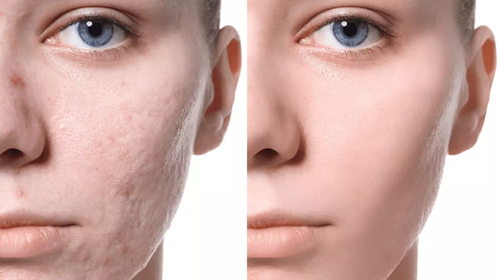 Cilt Çukurlarına Veda: Yosun Peeling Mucizesisini Keşfedin