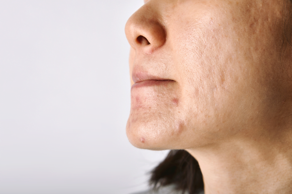 Cilt Çukurlarına Veda: Yosun Peeling Mucizesisini Keşfedin