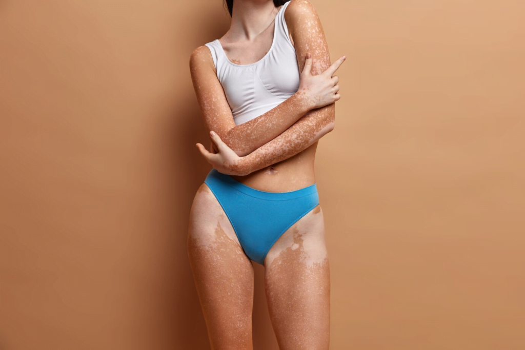 Yosun Peeling Leke Tedavisi: Cildinizdeki Lekelere Veda Edin