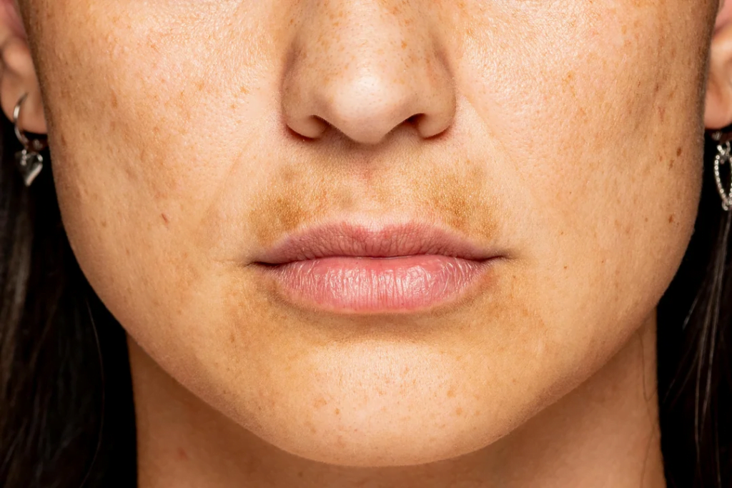 Yosun Peeling: Cilt Tonu Eşitsizliğine Doğal Bir Çözüm mü? 1