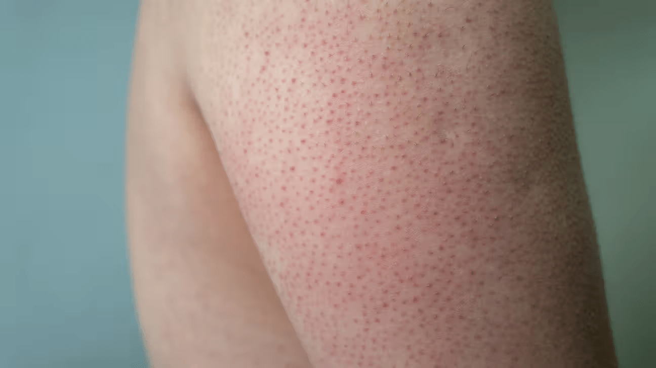 Kollarda Çilek Görünümü: Dermatolojik Bir Sorunun Arkasındaki Gerçekler 1