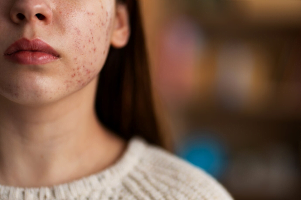 Yosun Peeling: Skar İzlerini Azaltmada Mucizevi Bir Çözüm mü? 1