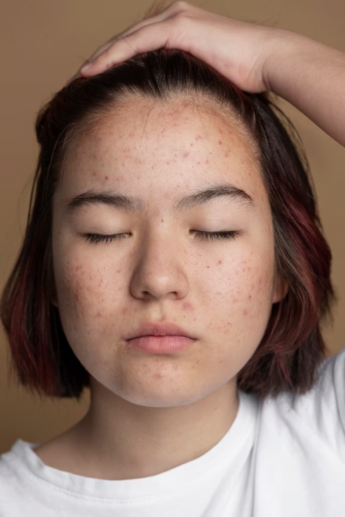 Yosun Peeling: Skar İzlerini Azaltmada Mucizevi Bir Çözüm mü? 3