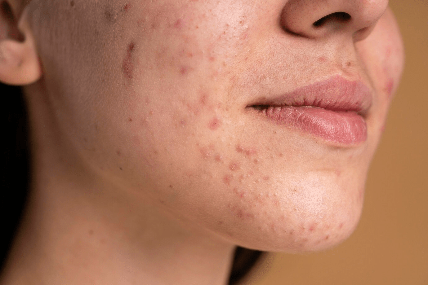 Yosun Peeling: Skar İzlerini Azaltmada Mucizevi Bir Çözüm mü?