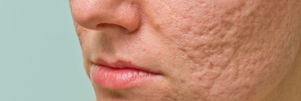 Yosun Peeling ile Yara İzi Kabusuna Son! Gerçekten İşe Yarıyor mu? 1