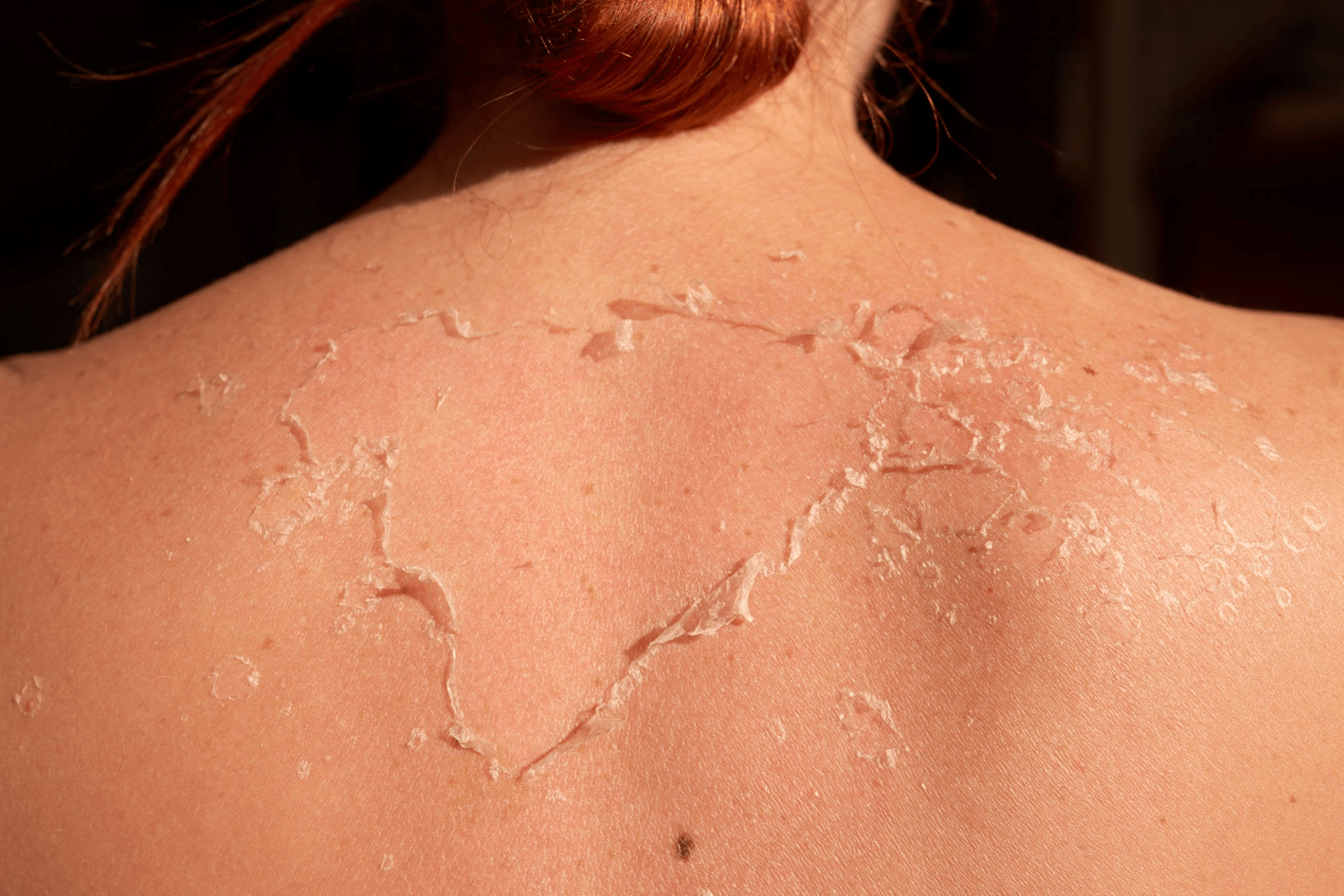 Yosun peeling sırta yapılır mı? 1
