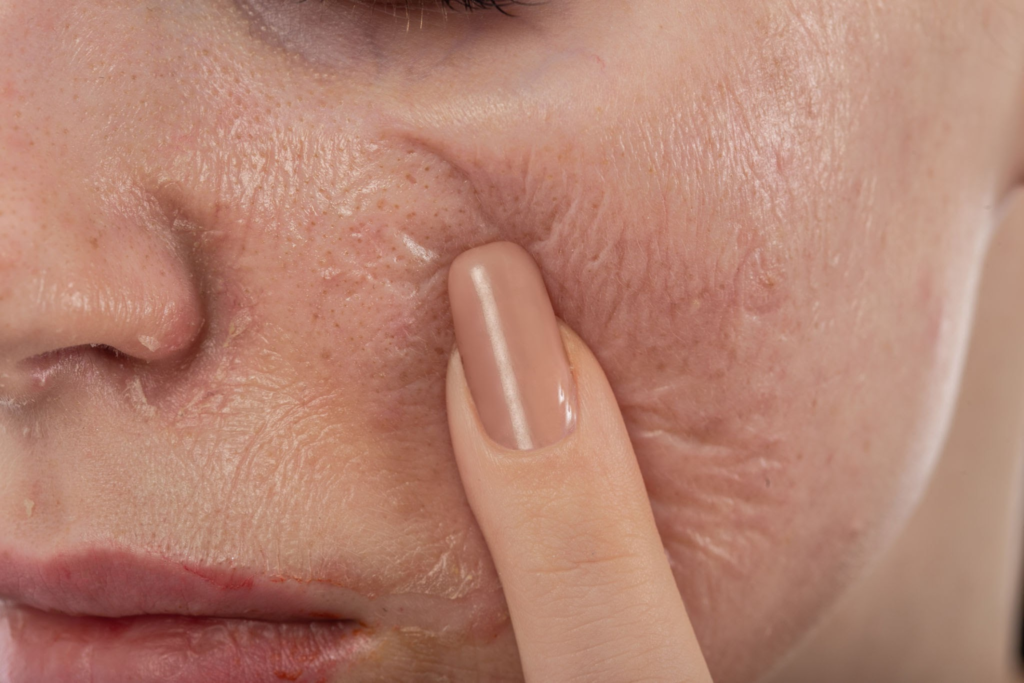 Yosun Peeling Soyulma Sürecinde Dikkat Edilmesi Gerekenler 6