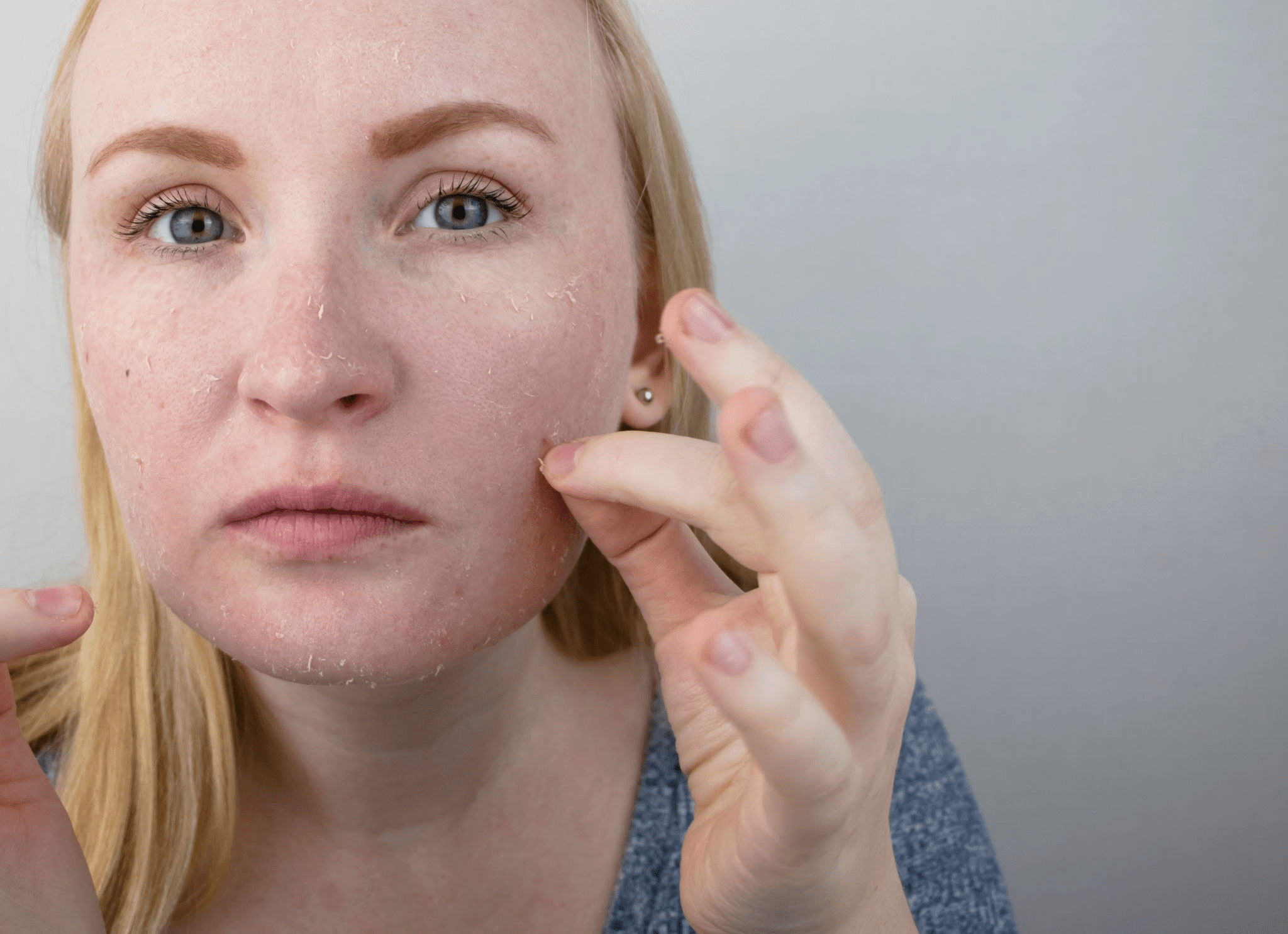 Yosun Peeling Soyulma Sürecinde Dikkat Edilmesi Gerekenler 1