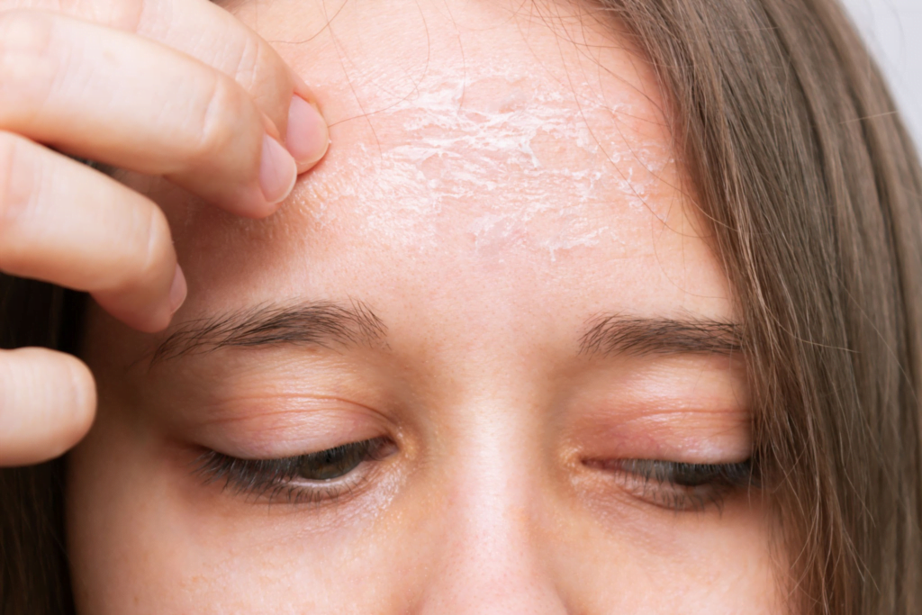 Yosun Peeling Soyulma Sürecinde Dikkat Edilmesi Gerekenler 7