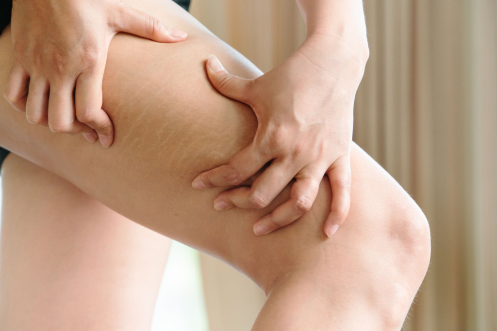 Yosun peeling soyulma işlemi selülit için etkili midir?