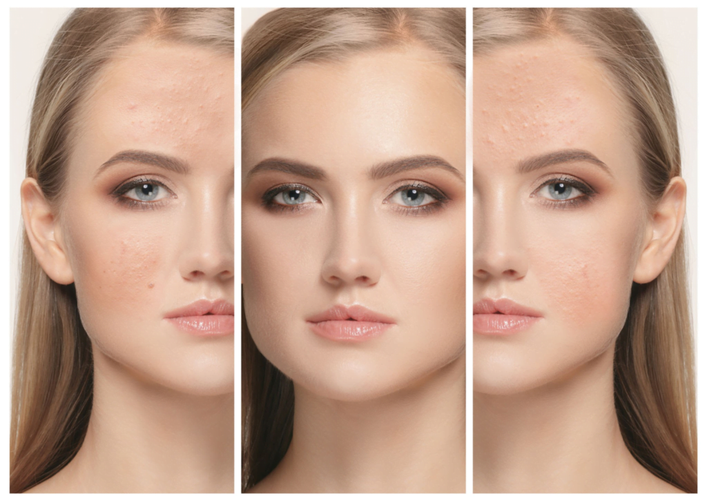 Yosun peeling sonuçları