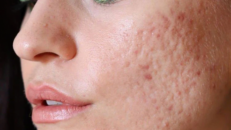 Yosun Peeling ile Yara İzi Kabusuna Son! Gerçekten İşe Yarıyor mu? 2