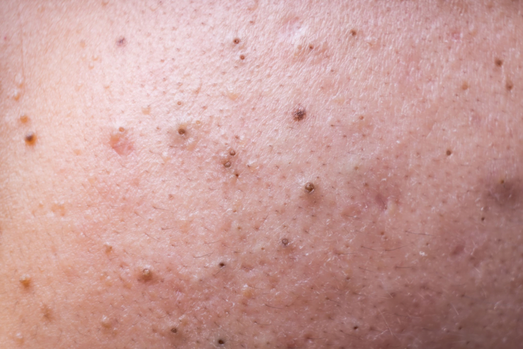 Siyah Noktalara Son! Yosun Peeling ile Cildinizi Arındırın ve Pürüzsüzleştirin 2