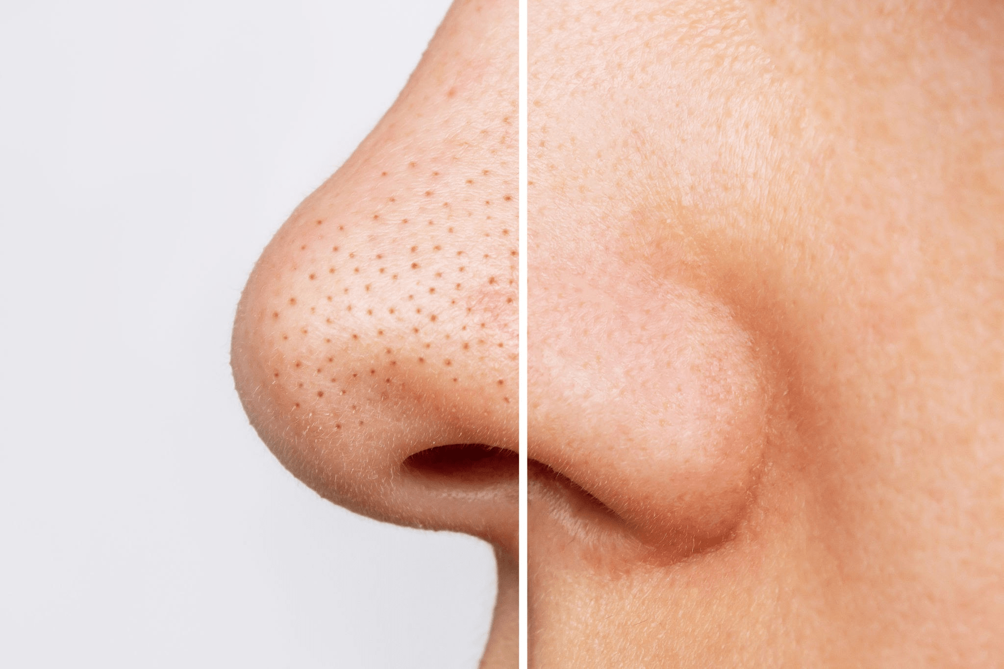 Siyah Noktalara Son! Yosun Peeling ile Cildinizi Arındırın ve Pürüzsüzleştirin