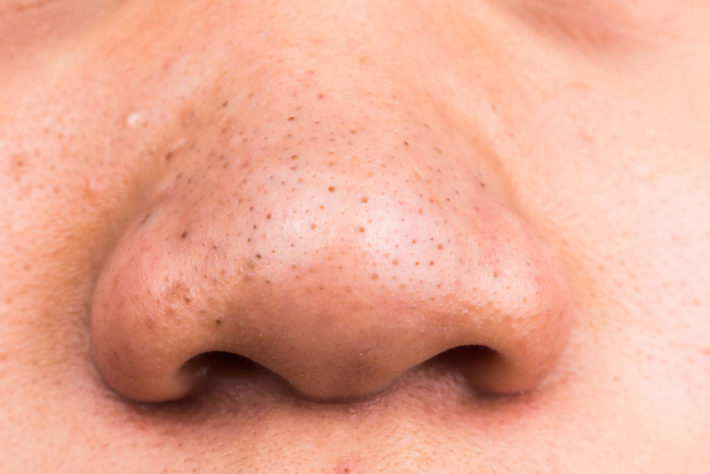 Siyah Noktalara Son! Yosun Peeling ile Cildinizi Arındırın ve Pürüzsüzleştirin