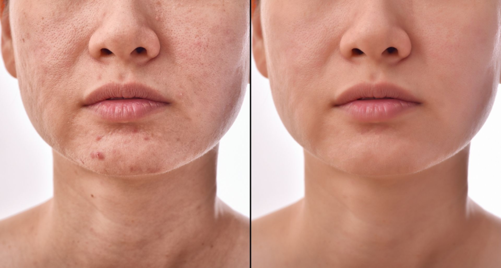 Yosun Peeling Yara İzi Tedavisinde Gerçekten İşe Yarıyor mu?