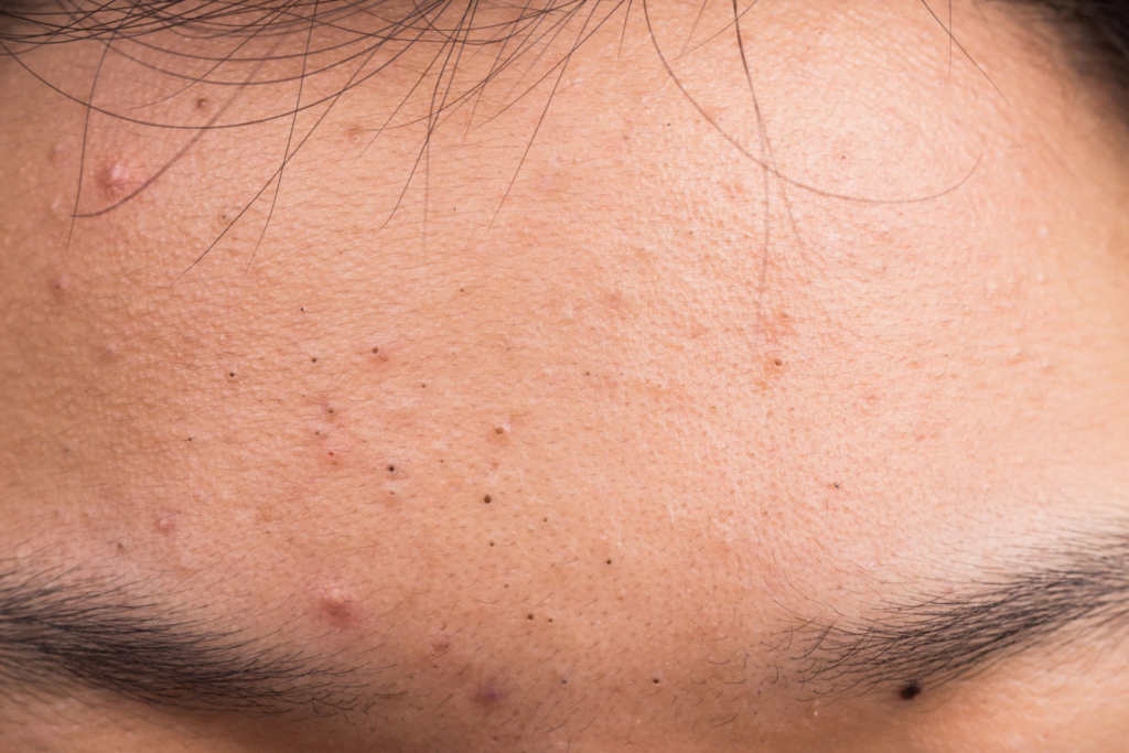 Siyah Nokta Bandı mı Yoksa Yosun Peeling mi? Cilt Bakımında Hangisi Daha Etkili? 1