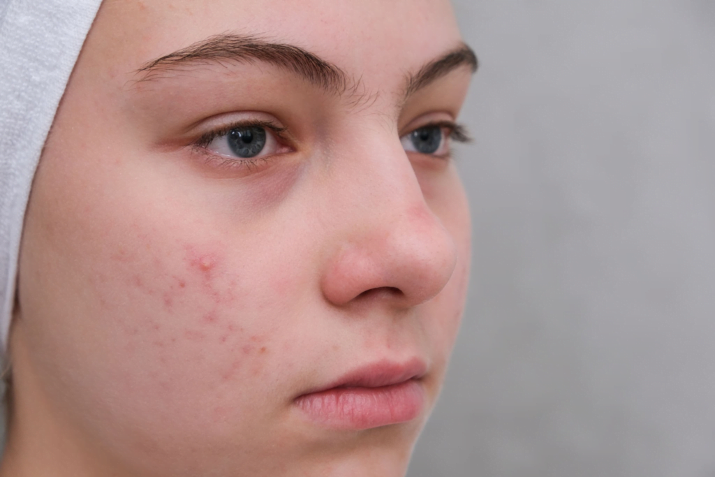 Sivilcelerden Ömür Boyu Kurtulmanın Sırrı Niacinamide mi?
