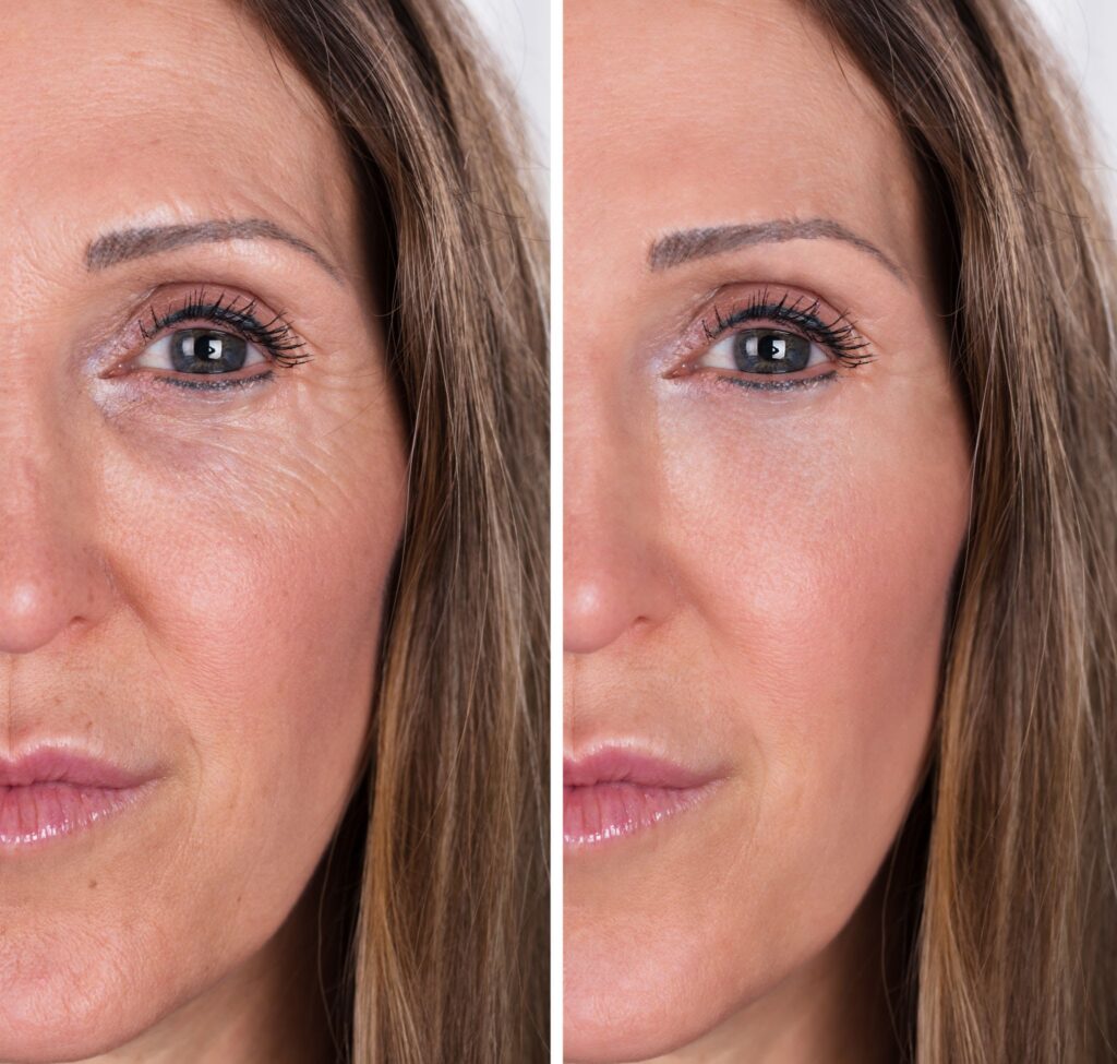 Kırışıklıklara Savaş Açın: Yosun Peeling Etkisi