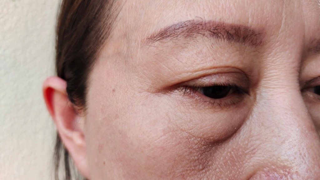 Yosun Peeling Sonrası Yüz Şişer mi? Kapsamlı Rehber