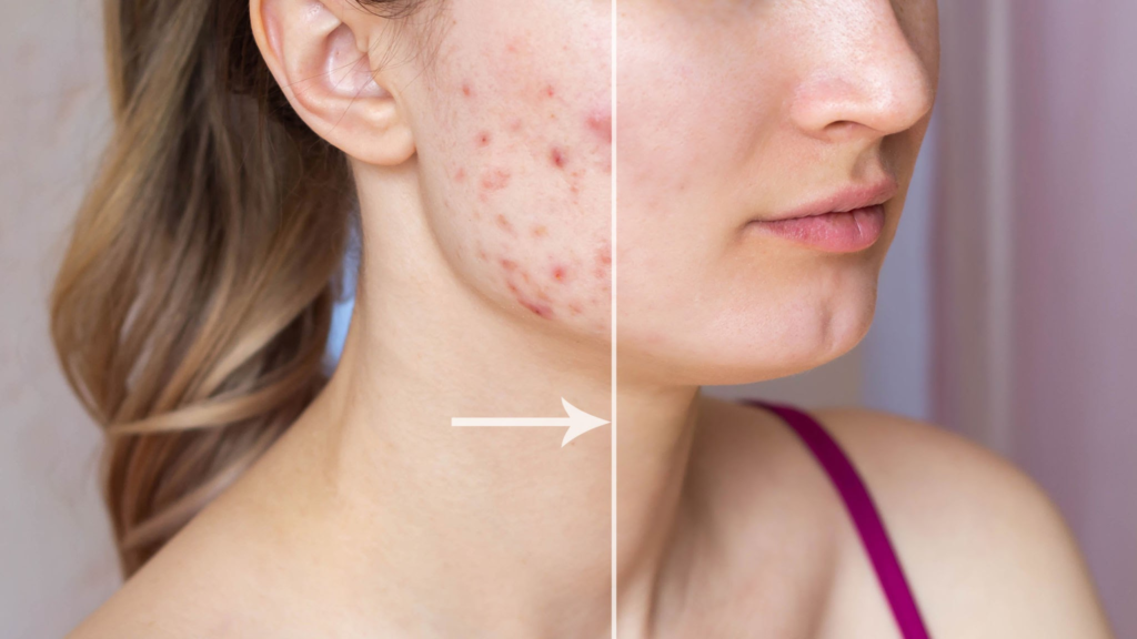 Akneli Ciltler İçin Yosun Peeling: Cildinizin Kurtarıcısı Olabilir mi? 3