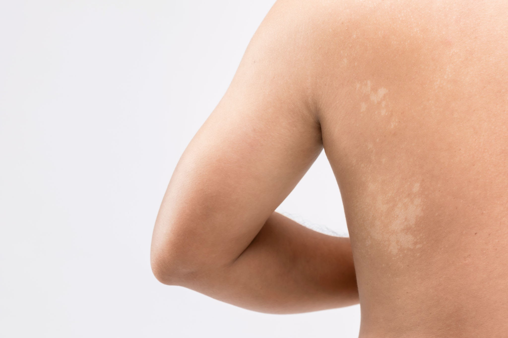 Vitiligo Olmayan Beyaz Lekeler: Nedenleri, Belirtileri ve Tedavi Seçenekleri 1