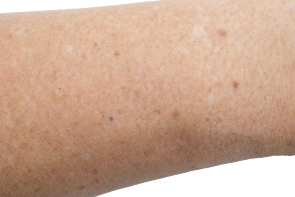 Vitiligo Olmayan Beyaz Lekeler: Nedenleri, Belirtileri ve Tedavi Seçenekleri 3