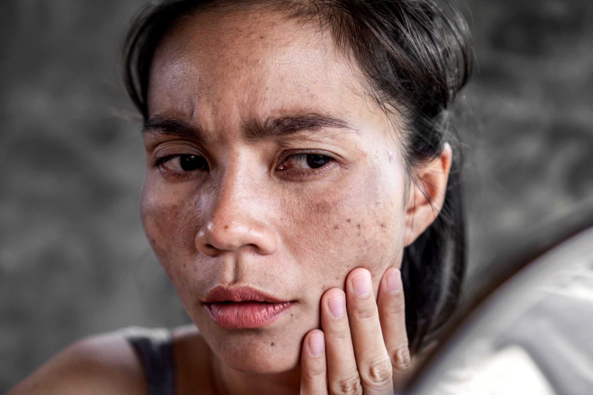 Vitiligo Olmayan Beyaz Lekeler Evde Tedavi Edilebilir mi? 5 Etkili Çözüm! 1