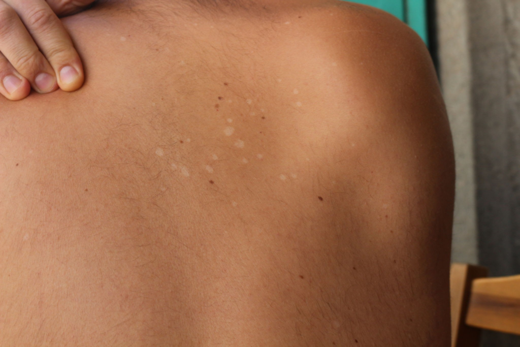 Vitiligo Olmayan Beyaz Lekeler Evde Tedavi Edilebilir mi? 5 Etkili Çözüm! 2