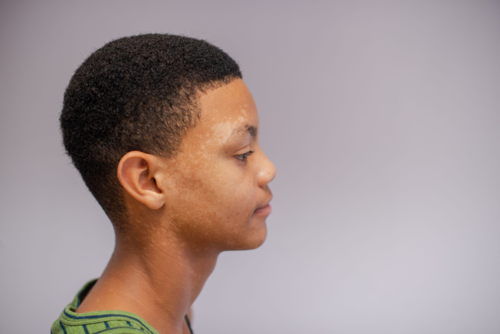 Vitiligo Olmayan Beyaz Lekeler Evde Tedavi Edilebilir mi? 5 Etkili Çözüm! 3