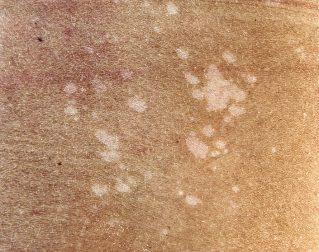 Vitiligo Olmayan Beyaz Lekeler Evde Tedavi Edilebilir mi? 5 Etkili Çözüm! 4
