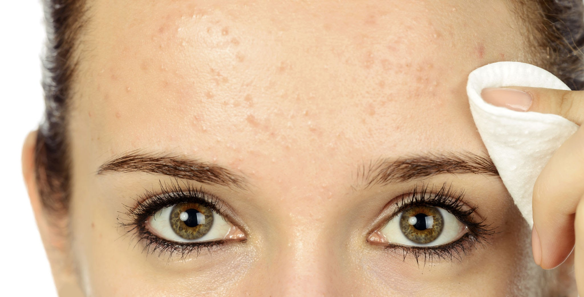 Kaş Ortasında Sivilce: Can Sıkıcı Bir Sorunun Nedenleri ve Çözümleri 1