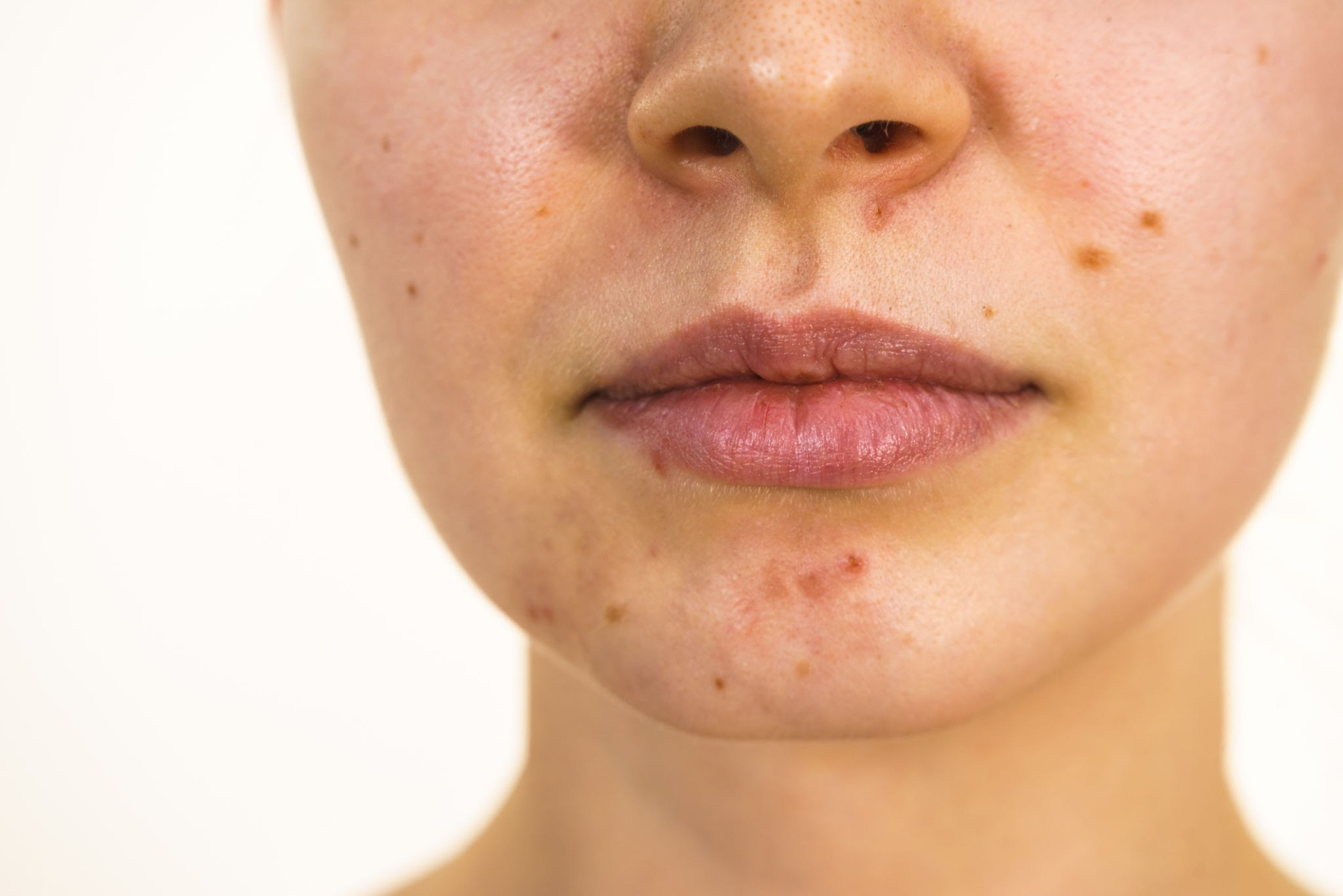 Çenede Sivilceyi Yok Etmenin Yolu: Yosun Peeling 1